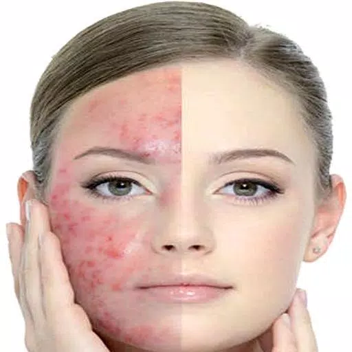 Get Rid of Acne (Guide) Screenshot 1
